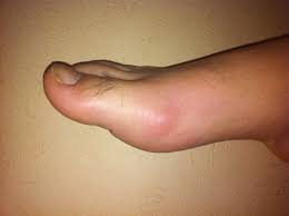 Gout, urate, uric, Rheumatologist, Allopurinol, colchicine, febuxostat